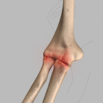 Arthroscopic Treatment of Elbow Arthritis
