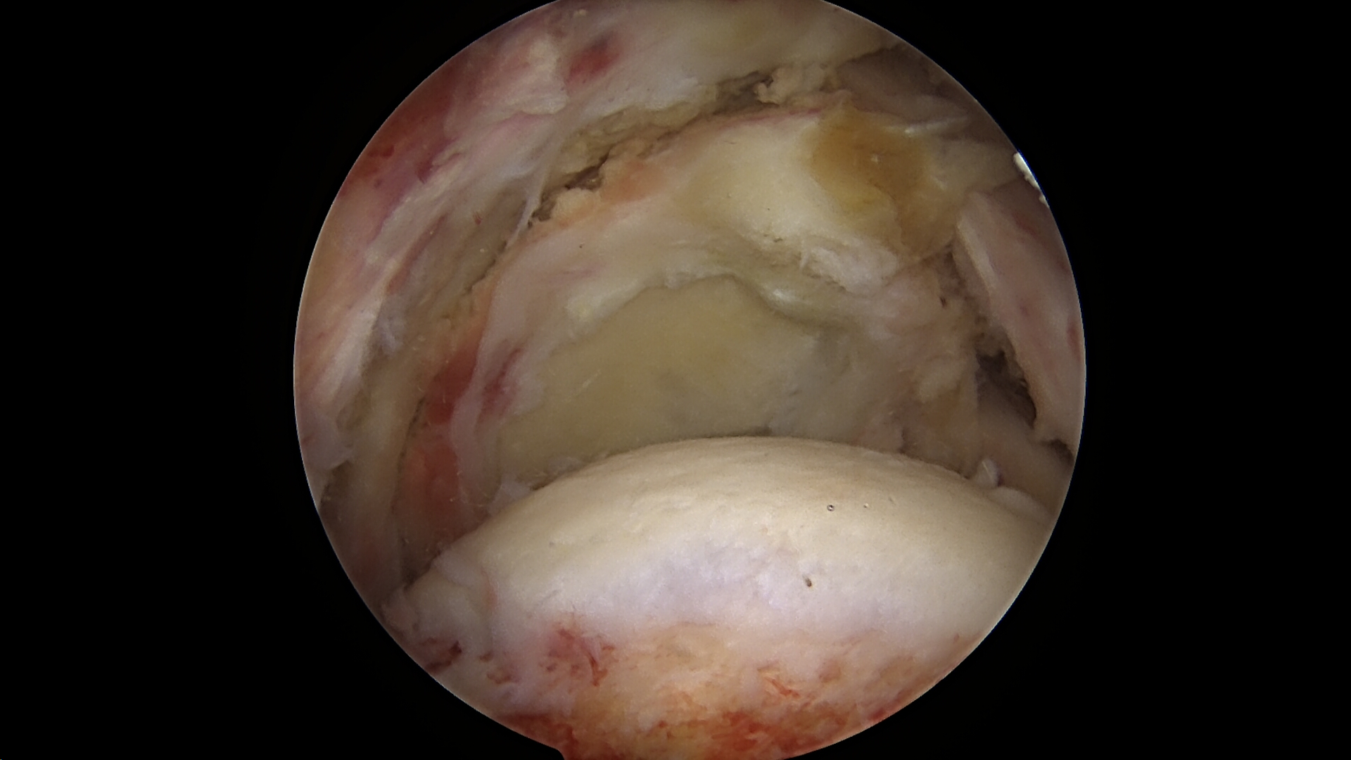 Massive retracted rotator cuff tear viewed from the lateral portal