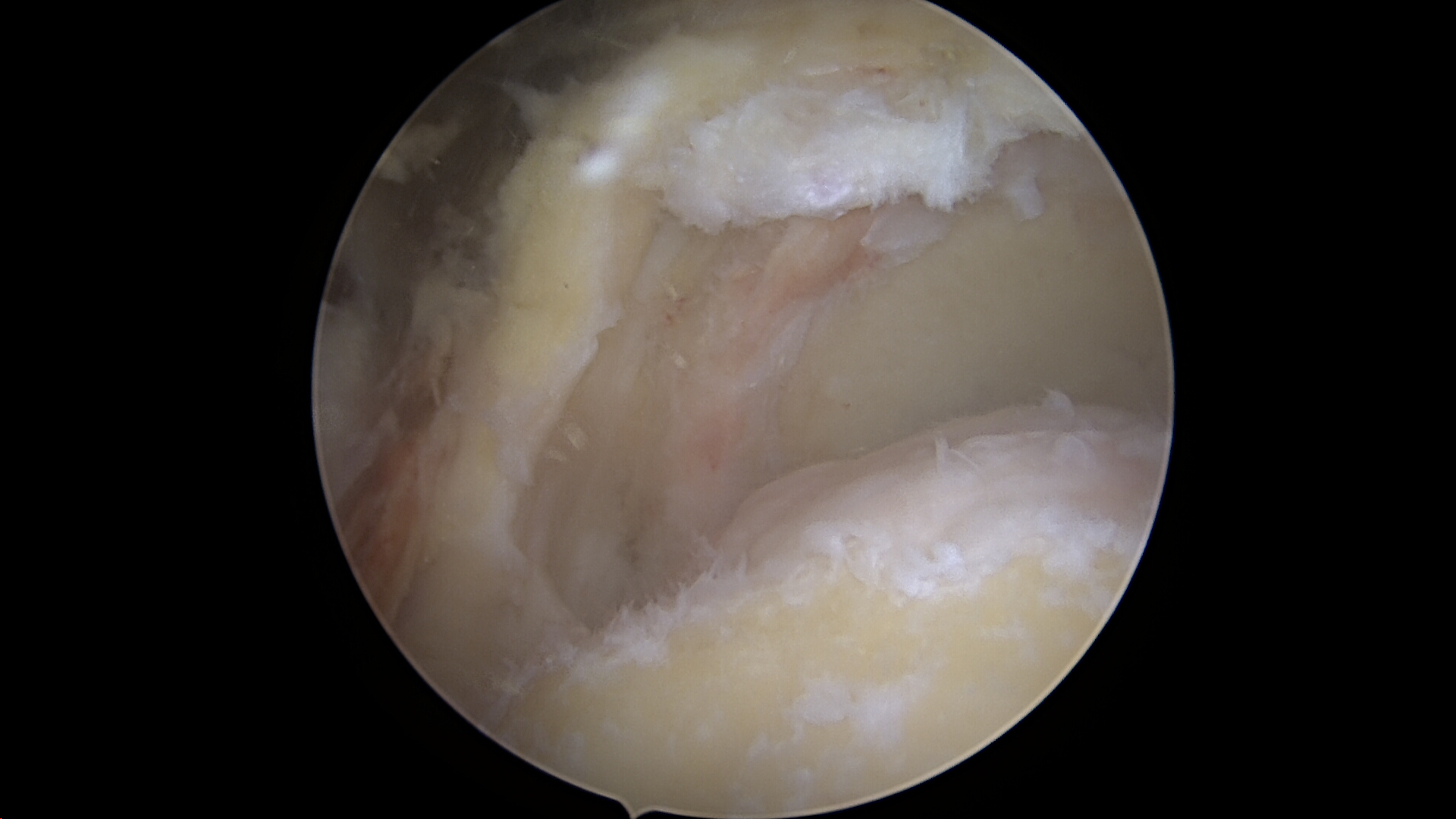 Massive irreparable rotator cuff tear viewed from the lateral portal