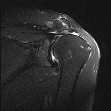 MRI showing massive retracted reparable rotator cuff tear