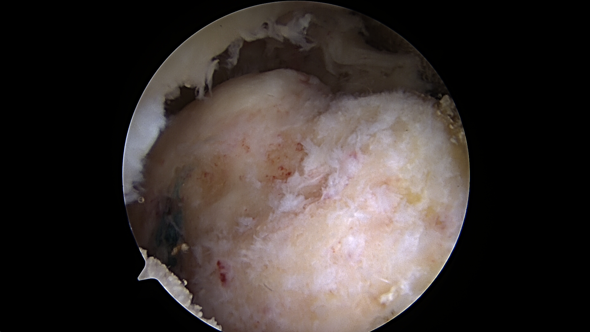 Massive retracted rotator cuff tear viewed from the posterior portal