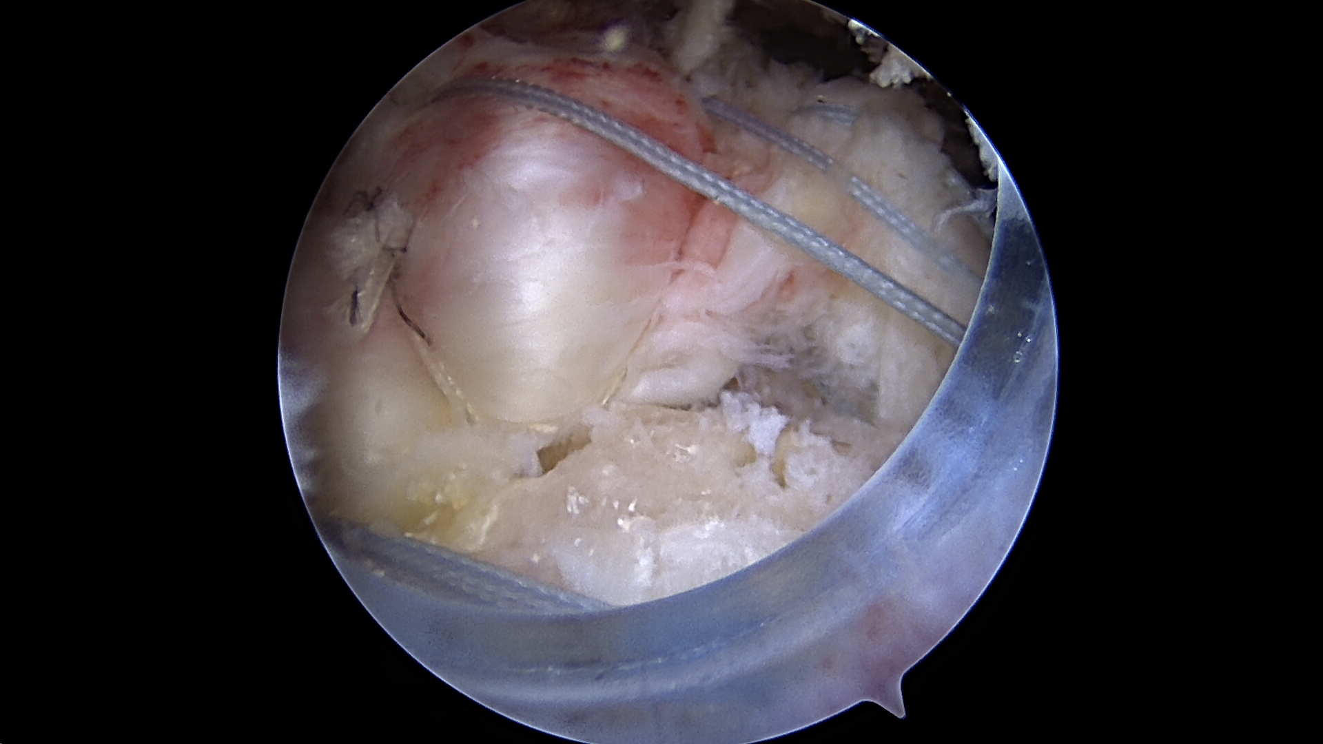 Single row medialized repair of previous massive retracted rotator cuff tear viewed from the lateral portal