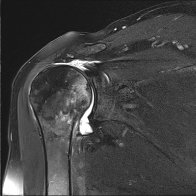 MRI showing massive retracted irreparable rotator cuff tear