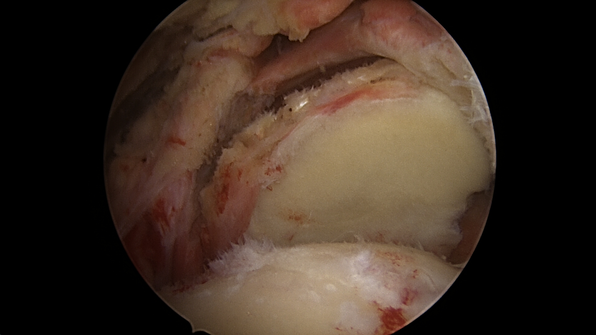 Massive retracted irreparable rotator cuff tear viewed from the lateral portal