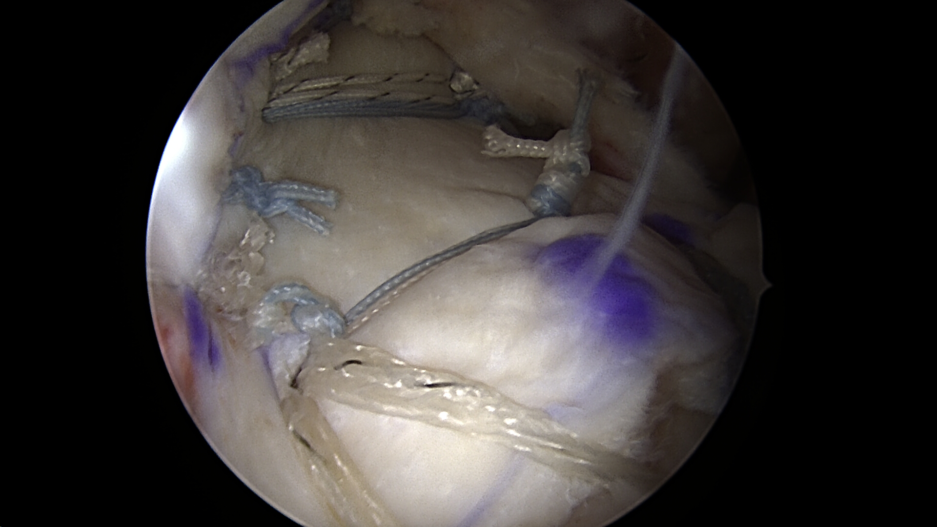 Superior capsule reconstruction of the previous massive retracted irreparable rotator cuff tear viewed from the lateral portal