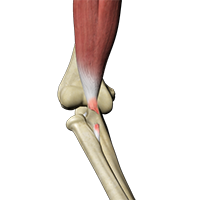 Distal Biceps Tendon Rupture Repair and Reconstruction