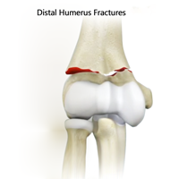 Humerus Fracture