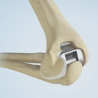 Revision Elbow Replacement