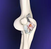 Elbow Ligament Reconstruction