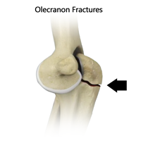 Olecranon Fracture