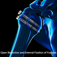 Open Reduction and Internal Fixation (ORIF)