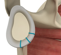 Shoulder Instability and Labral Repair