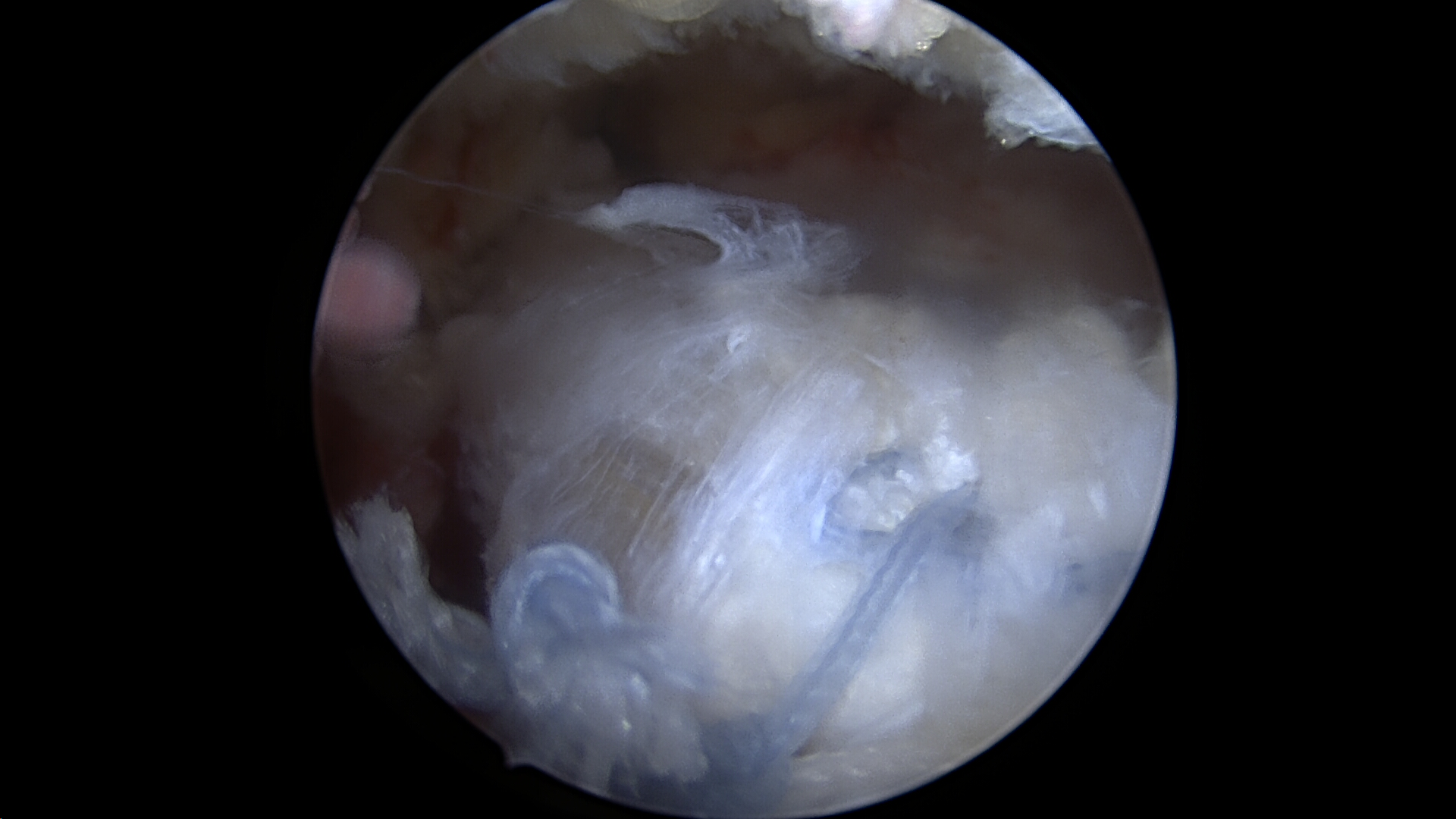 Arthroscopic assisted lower trapezius transfer using Achilles tendon allograft viewed from the lateral portal of the prior irreparable massive rotator cuff tear