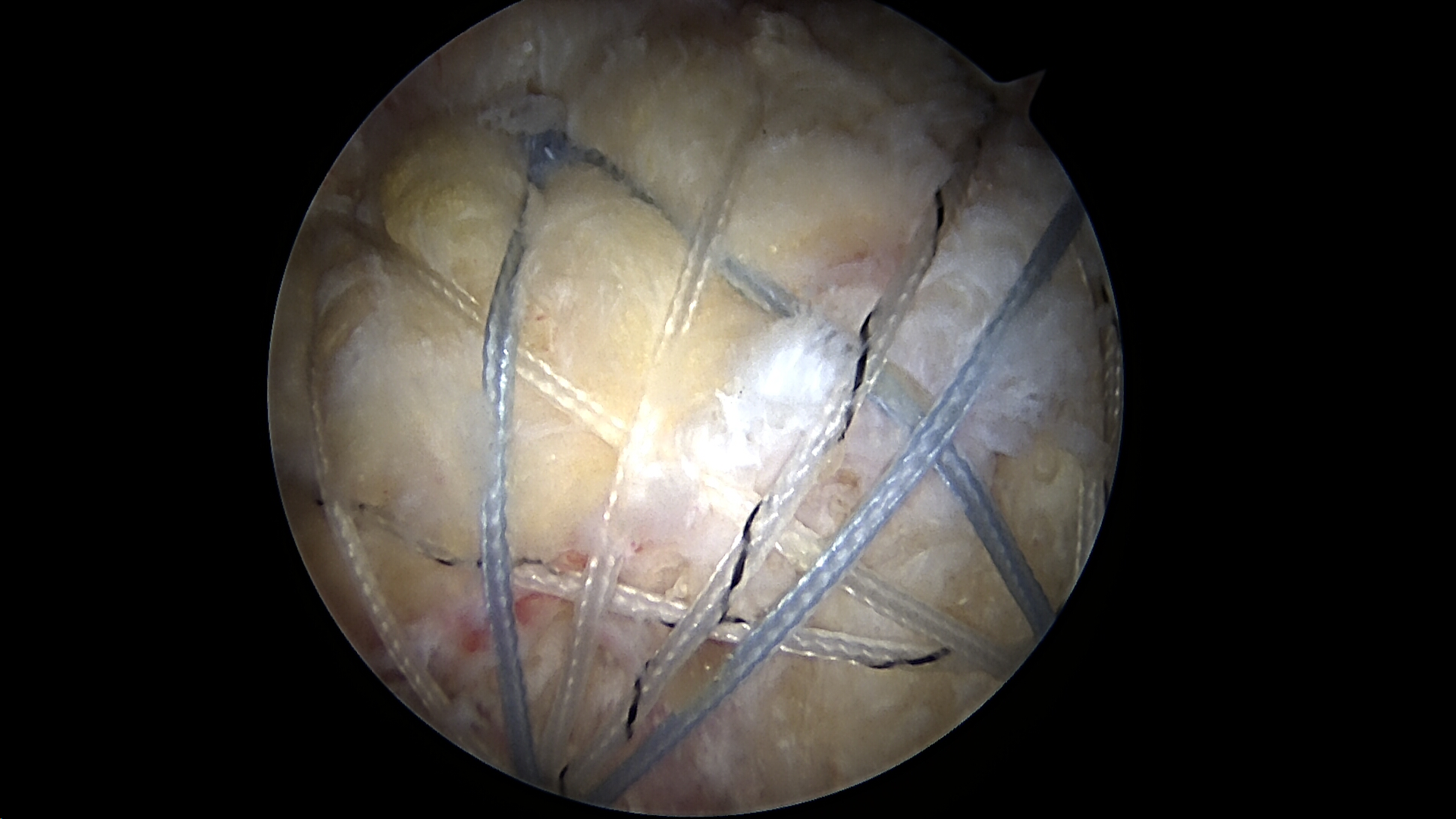 >Arthroscopic suture bridge double row rotator cuff repair of massive retracted rotator cuff tear viewed from the lateral portal