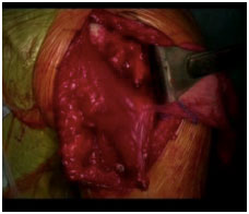 Released pectoralis major tendon