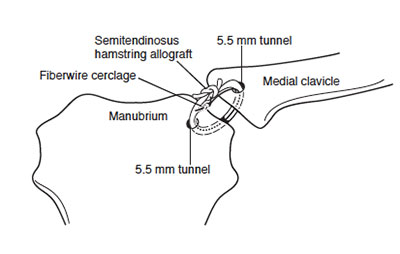 sternoclavicular reconstruction