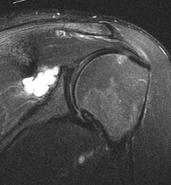 Spinoglenoid notch cyst causing compression of the suprascapular nerve