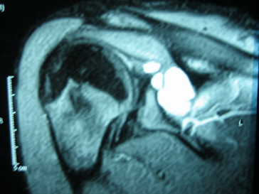 MRI image of a spinoglenoid notch cyst