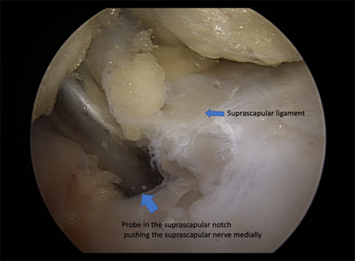 Suprascapular ligament is the white band of tissue running horizontally in the image